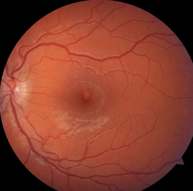 Laser Pointer Maculopathy Macular Appearance Laser pointer maculopathy: fundus photograph of the macula following laser exposure