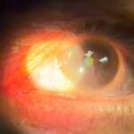Latent Nystagmus Fusion Maldevelopment: clinical photograph