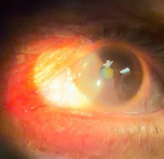 Latent Nystagmus: The Eye Movement That Appears Only on Cover Testing