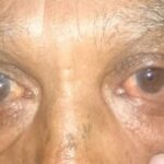 Lateral tarsal strip procedure: patient with lower eyelid laxity during the lateral distraction test