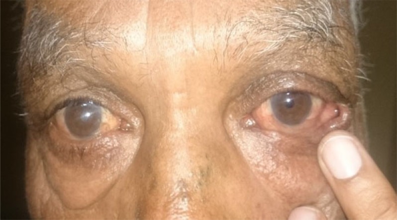 Lateral Tarsal Strip Lateral Distraction Test Lateral tarsal strip procedure: patient with lower eyelid laxity during the lateral distraction test