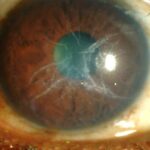Lattice Corneal Dystrophy