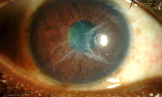Lattice Corneal Dystrophy: When Corneal Lines Signal Systemic Amyloidosis