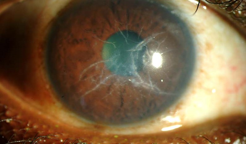 Lattice Corneal Dystrophy