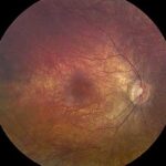 Leber congenital amaurosis: fundus photograph showing a relatively normal-appearing retina despite severe visual loss