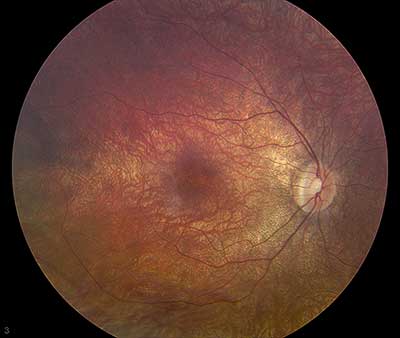 Leber Congenital Amaurosis: A Normal Fundus, a Silent ERG