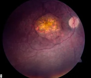 Leber Congenital Amaurosis Macular Atrophy Leber congenital amaurosis: fundus photograph showing macular atrophic changes