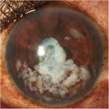 Lens Particle Glaucoma Anterior Chamber Debris Lens particle glaucoma: slit-lamp photograph showing lens material and inflammatory debris in the anterior chamber