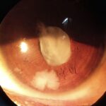 Lens particle glaucoma: slit-lamp photograph showing retained lens cortical material in the anterior chamber