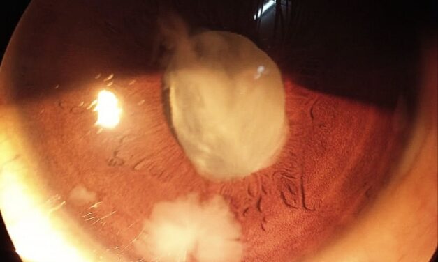 Lens-Particle Glaucoma: When Retained Cortex Blocks the Angle