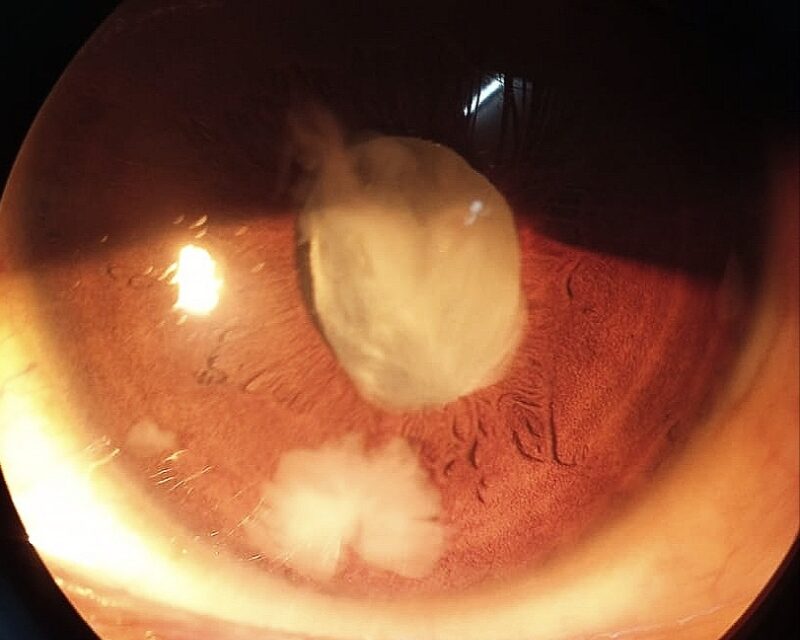 Lens-Particle Glaucoma: When Retained Cortex Blocks the Angle