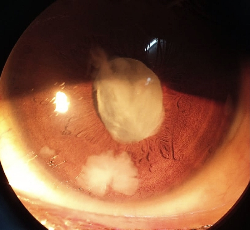 Lens Particle Glaucoma Retained Cortex Lens particle glaucoma: slit-lamp photograph showing retained lens cortical material in the anterior chamber