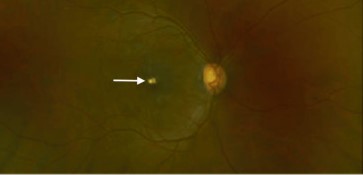 Leukemic retinopathy: color fundus photograph after treatment showing resolution of hemorrhages with a residual small lesion (arrow)