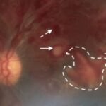 Leukemic retinopathy: color fundus photograph showing retinal hemorrhages and white-centered lesions marked by arrows