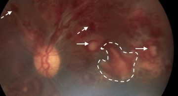 Leukemic Retinopathy: What the Fundus Reveals About the Blood