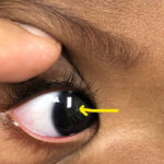 Leukocoria: white pupillary reflex in the right eye of a child (arrow)