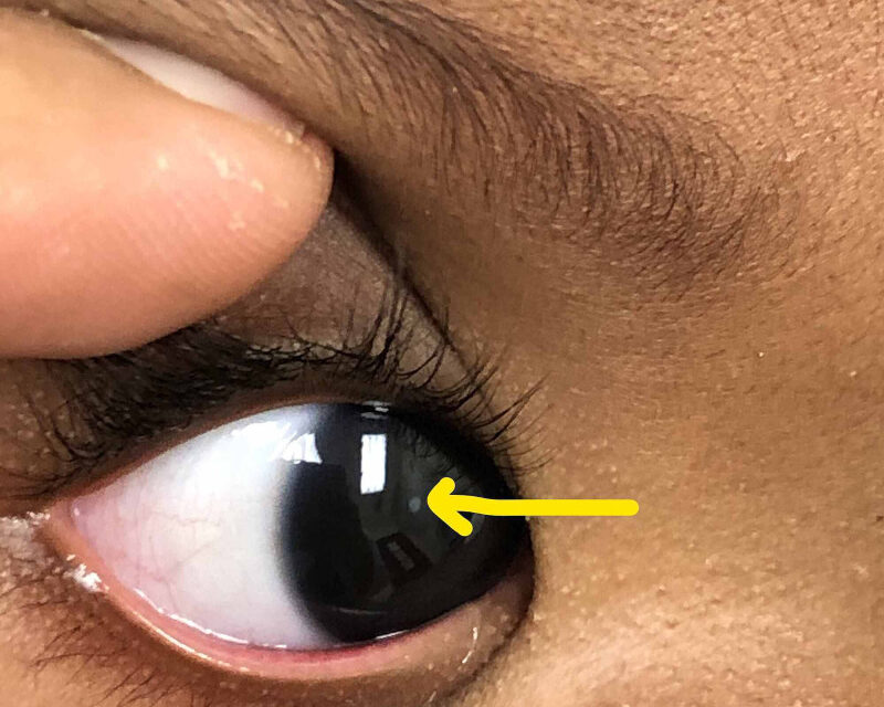Leukocoria: The White Reflex That Demands a Systematic Workup