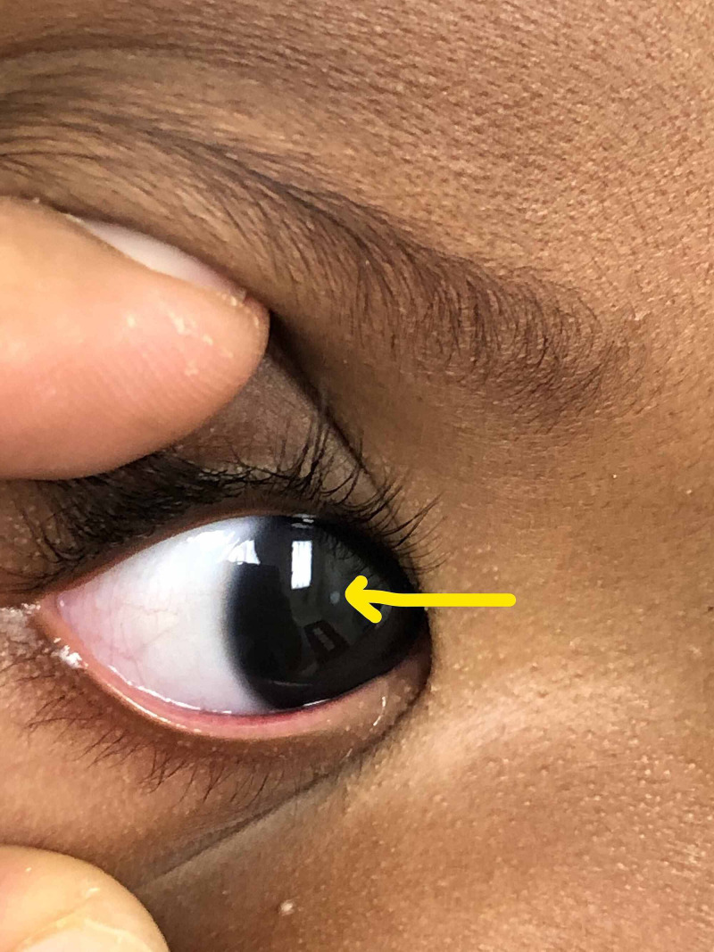 Leukocoria: white pupillary reflex in the right eye of a child (arrow)