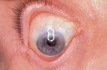Ligneous conjunctivitis: eye with a thick membranous mass over the conjunctiva