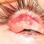 Ligneous conjunctivitis: everted eyelid showing a dense woody membrane on the upper tarsal conjunctiva