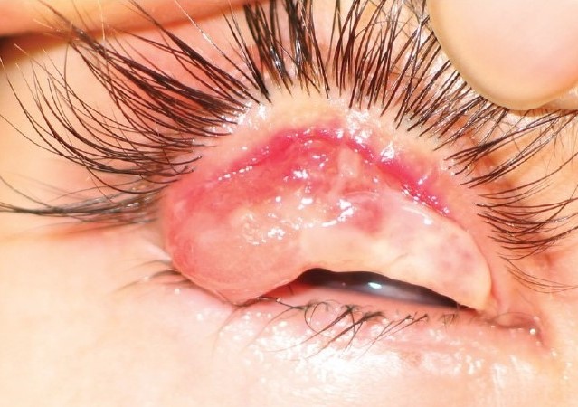 Ligneous Conjunctivitis: A Systemic Clotting Disorder Wearing a Membrane