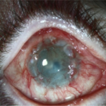 Clinical eye photograph illustrating Limbal Stem Cell Deficiency Classification