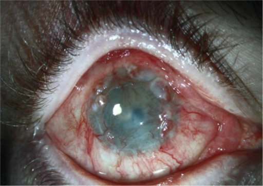 Limbal Stem Cell Deficiency: When the Cornea Loses Its Own Repair Crew