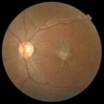 Macular buckle surgery: fundus photograph showing a posterior staphyloma in a highly myopic eye