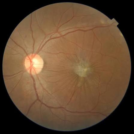 Macular Buckle Surgery: Treating the Staphyloma, Not Just the Traction