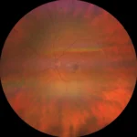 Macular neovascularization: fundus photograph showing a macular neovascular lesion