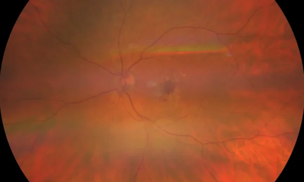 Macular Neovascularization: Types 1, 2 and 3 and What They Mean at the Bedside
