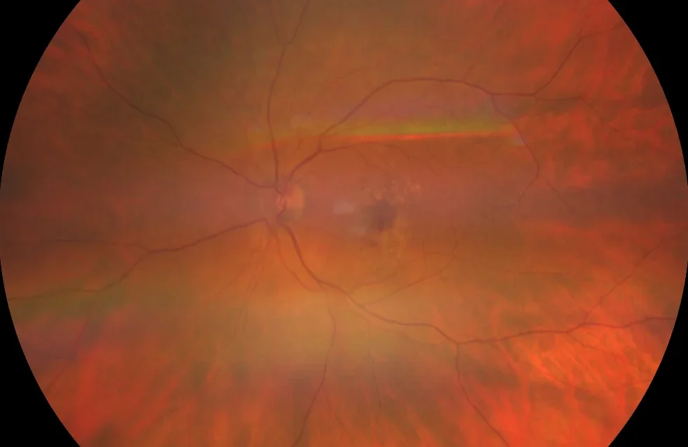 Macular Neovascularization: Types 1, 2 and 3 and What They Mean at the Bedside
