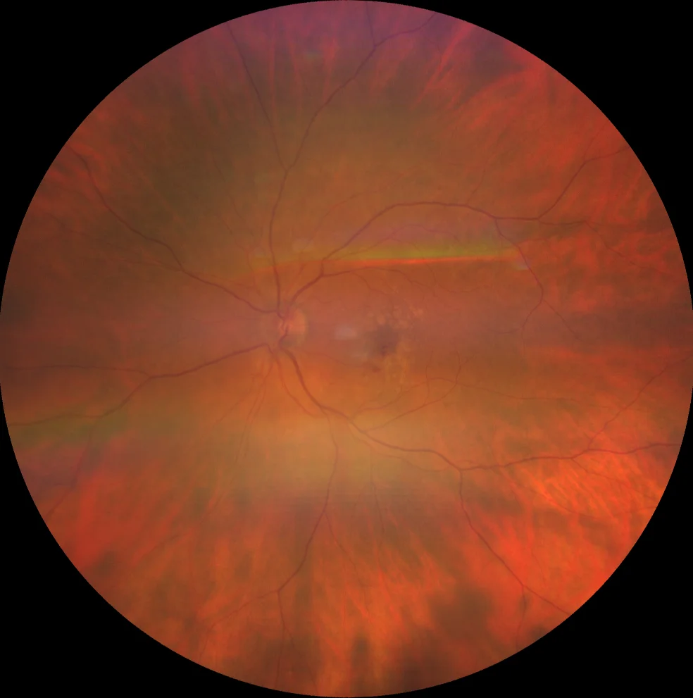 Macular Neovascularization Fundus Lesion Macular neovascularization: fundus photograph showing a macular neovascular lesion