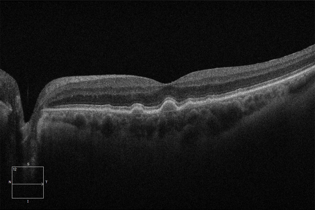 Macular Neovascularization OCT Subretinal Fluid Macular neovascularization: OCT B-scan showing subretinal fluid and an irregular retinal pigment epithelium elevation
