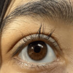Madarosis: eyelid margin during recovery with eyelash regrowth