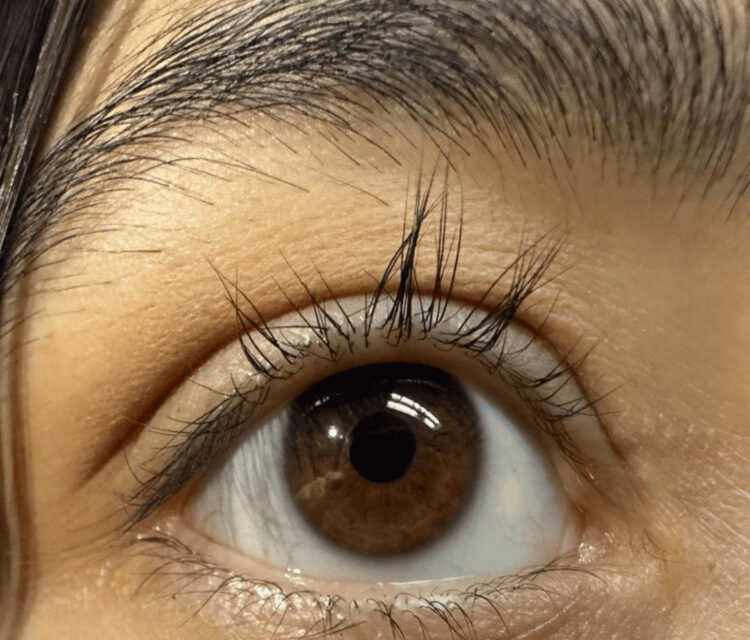 Madarosis: What Lash Loss Is Actually Telling You
