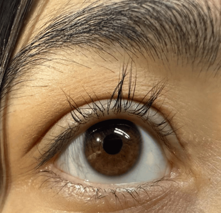 Madarosis: eyelid margin during recovery with eyelash regrowth