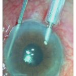Malignant glaucoma: intraoperative photograph during peripheral iridectomy, capsulo-hyaloidectomy, and anterior vitrectomy