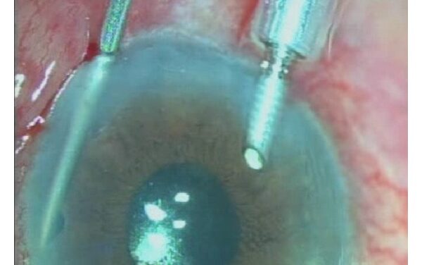 Malignant Glaucoma: The Emergency That Looks Like Pupillary Block