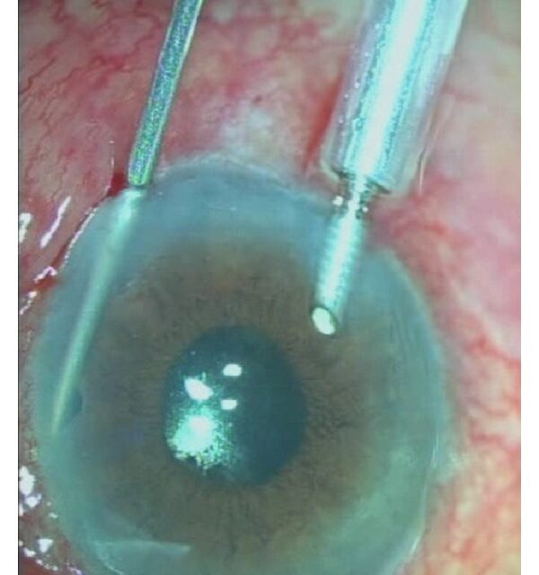 Malignant Glaucoma: The Emergency That Looks Like Pupillary Block