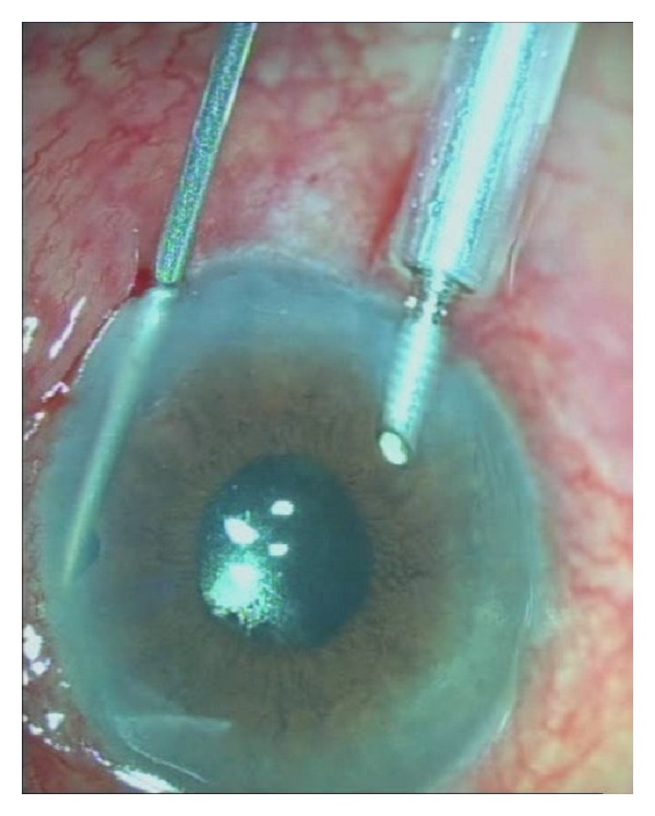 Malignant Glaucoma Iridectomy and Vitrectomy Malignant glaucoma: intraoperative photograph during peripheral iridectomy, capsulo-hyaloidectomy, and anterior vitrectomy