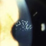 Map-dot-fingerprint dystrophy: slit-lamp photograph showing epithelial dots in the corneal epithelium