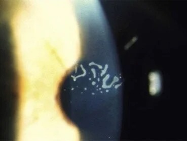 Map-Dot-Fingerprint Dystrophy: The Hidden Cause of Recurrent Erosion