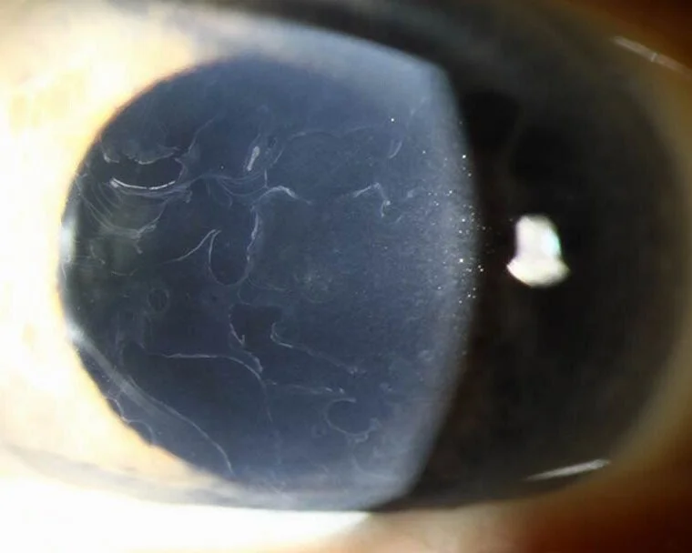 Map-Dot-Fingerprint Dystrophy Fingerprint Lines Map-dot-fingerprint dystrophy: slit-lamp photograph showing fine fingerprint-like epithelial lines