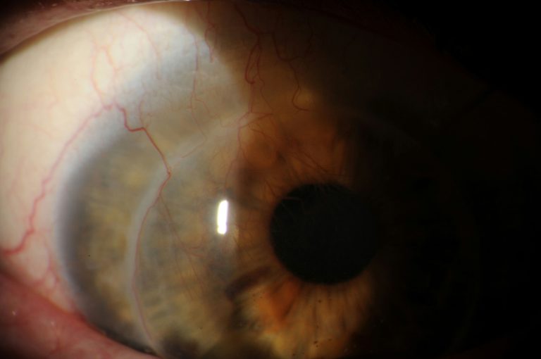 Corneal Graft Rejection