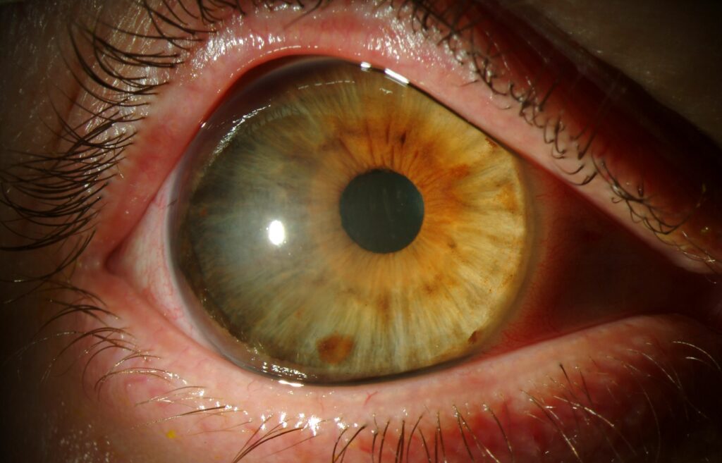 Megalocornea