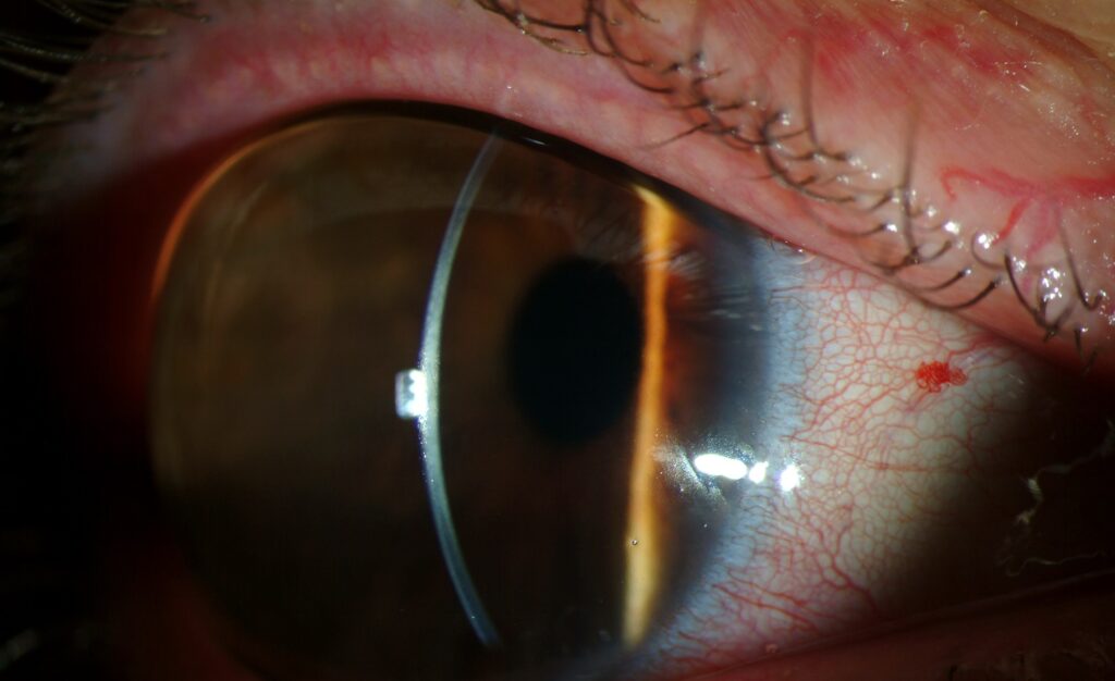 Megalocornea