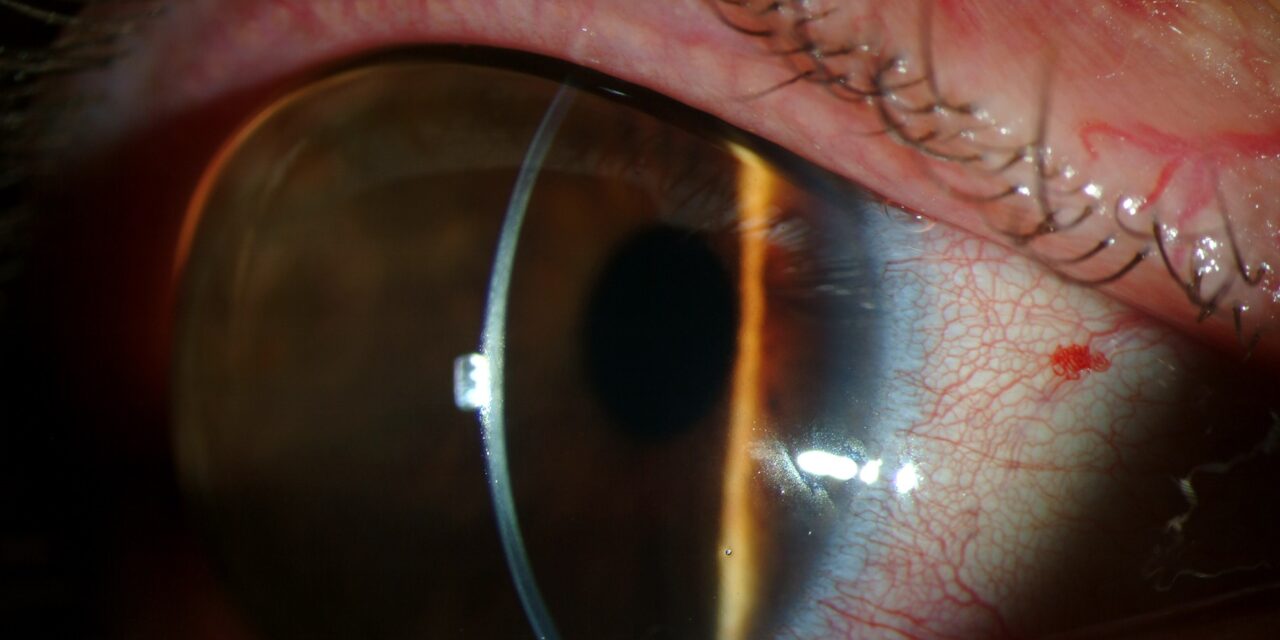 Megalocornea: Large but Normal, and Why That Distinction Is Urgent