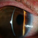Megalocornea
