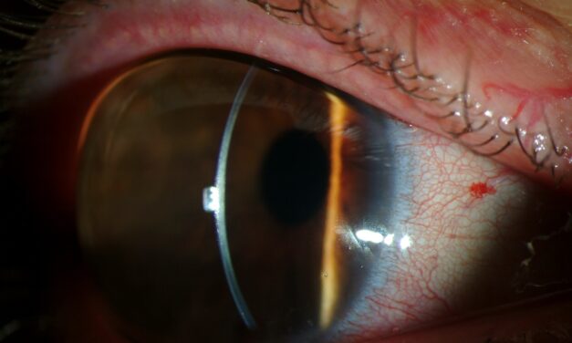 Megalocornea: Large but Normal, and Why That Distinction Is Urgent